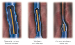 Endovenous Ablation Therapy