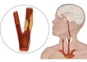 Carotid Artery Disease