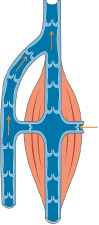 CVI illustration
