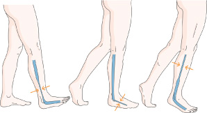 Chronic Venous Insufficiency (CVI), Department of Surgery