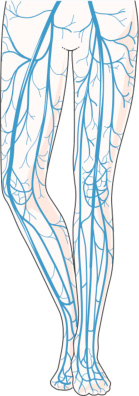CVI illustration