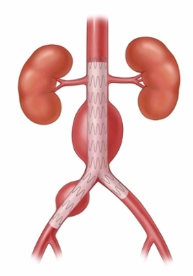 Fusiform aneurysm, endovascular repair.