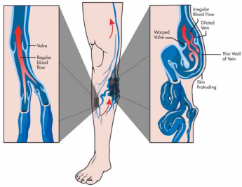 Premier Vein & Vascular - Tampa, FL & Largo, FL - Types of Varicose Veins