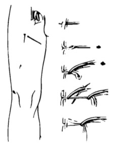 Varicose Vein illustration