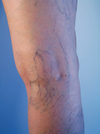 Spider veins
