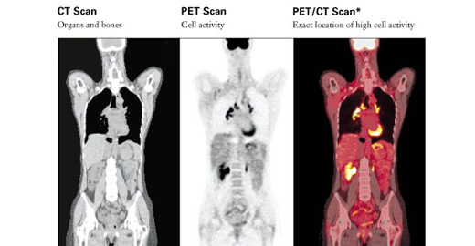 Comparison between CT scan, PET scan and PET/CT scan images of the same area.