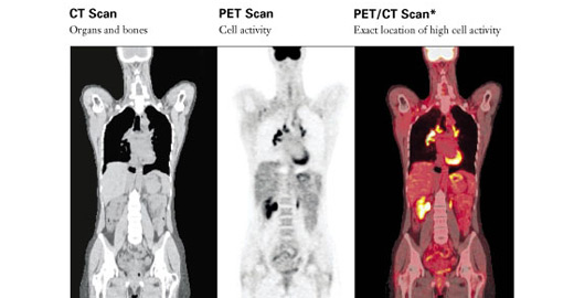 PET/CT