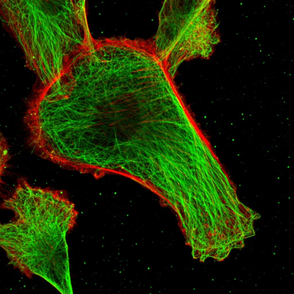 breast cancer cell photographed by Nick Deakin, PhD