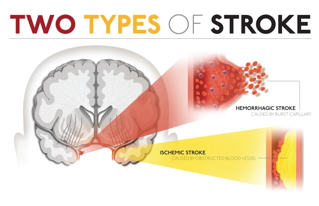 Undersheriff Warren Darby suffered a hemorrhagic stroke when a small capillary burst in his brain. The majority of strokes, however, are ischemic, meaning they are caused by clots that obstruct blood vessels in the brain. Symptoms alone don‘t reveal which type of stroke a person is having, a computerized tomography scan can usually differentiate. At Upstate University Hospital, interventional neuro-radiologists treat some patients with ischemic strokes using stent devices to retrieve clots from the brain. And, neurologists offer clinical trials to some patients with hemorrhagic strokes near the surface of the skull. The trials use a medication injected through a catheter at the site of the hemorrhage to break up the clotted blood and reduce swelling. These are among the unique services that are available at Upstate, the first designated stroke center in Central New York.
