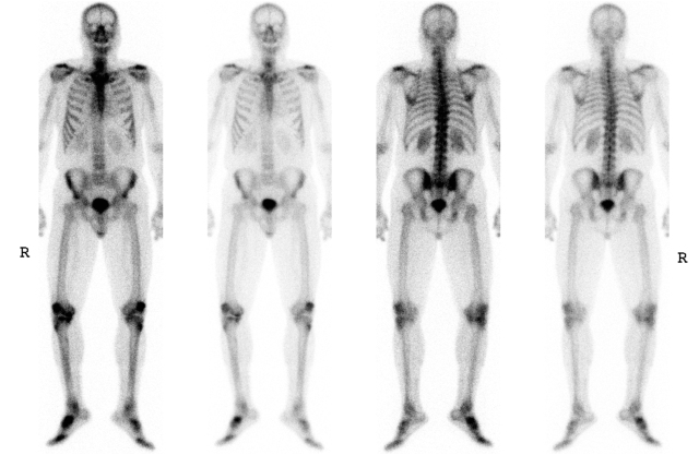 A current bone scan done using Tc99m-MDP, an imaging agent developed at Upstate in the 1970s. Courtesy Department of Radiology, Division of Nuclear Medicine