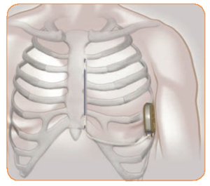 The device is sewn beneath the skin.
