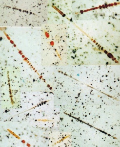 Jerrold Abraham, MD, provided this image from a paper he co-authored in 2002 in the American Journal of Respiratory and Critical Care Medicine, from a case about someone who died from asbestosis 50 years after a brief exposure in a Vermiculite expansion plant.