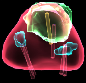 This red triangle is a 3-D image of Paul Kruger's prostate. The circular colored areas are areas of suspicion, as indicated by a magnetic resonance imaging scan. Using Upstate's UroNav fusion biopsy system, Srinivas Vourganti, MD, hones in on areas where cancer may be hiding. The cylinders show where the urologic oncologist removed tissue samples for biopsy. Cancer cells were found to occupy about a third of Kruger's prostate, in the green circular region.
