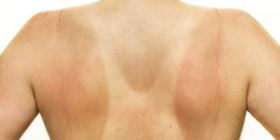 5 things to do to treat a sunburn