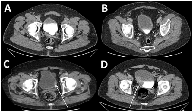 A. shows the normal bladder appearance. Among radiographic bladder wall abnormalities are B. diffuse bladder wall thickening, C. focal bladder wall thickening and D. bladder mass.