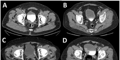 When to be concerned about bladder cancer