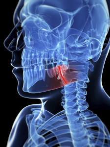 medical illustration of a broken jaw bone
