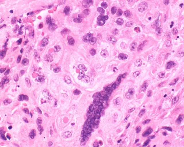 NY_v014 poxvirus reprinted from Nelli S. Lakis, Yu Li, Jerrold L. Abraham, Chris Upton, Donald C. Blair, Scott Smith, Hui Zhao, and Inger K. Damon, Novel Poxvirus Infection in an Immune Suppressed Patient, Clinical Infectious Diseases, 2015, 60: 1543-1548. By permission of Oxford University Press.