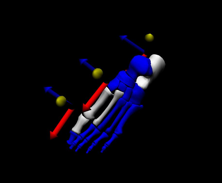 Three-dimensional model of the foot of a patient enrolled in a clinical trial on flat foot deformity. From the lab of Christopher Neville, PhD, Upstate Medical University. (Model generated with The Motion Monitor (Innsport Inc. Chicago, IL).