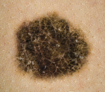Close-up of a melanoma.