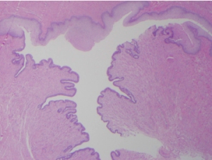 A buccal mucosa engraftment. (FROM THE LAB OF DMITRIY NIKOLAVSKY, MD)