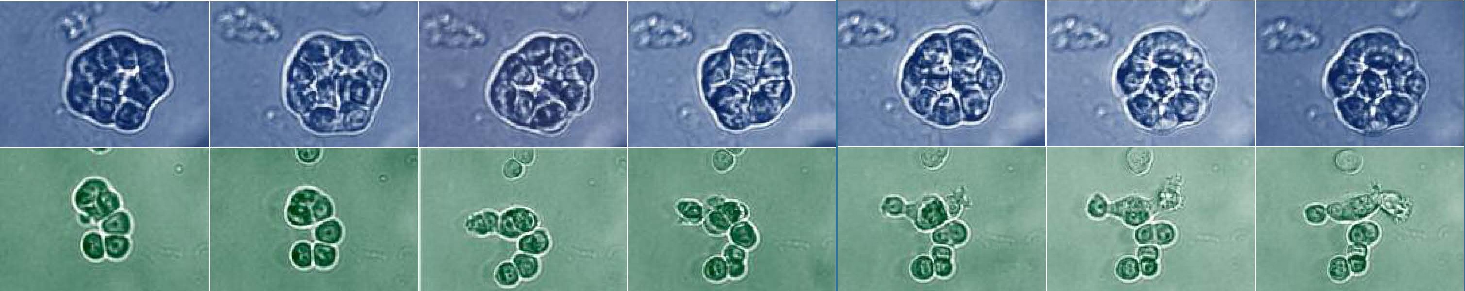 Still images from two videos of prostate cell growth. The cluster of cells on the top, in blue, are spherical, indicating healthy cell growth. The images on the bottom, which has had the gene/protein Abi1 removed, show cell clusters that are nonspherical and loosely attached, and are trying to migrate out. (FROM THE LAB OF LESZEK KOTULA, MD, PhD)