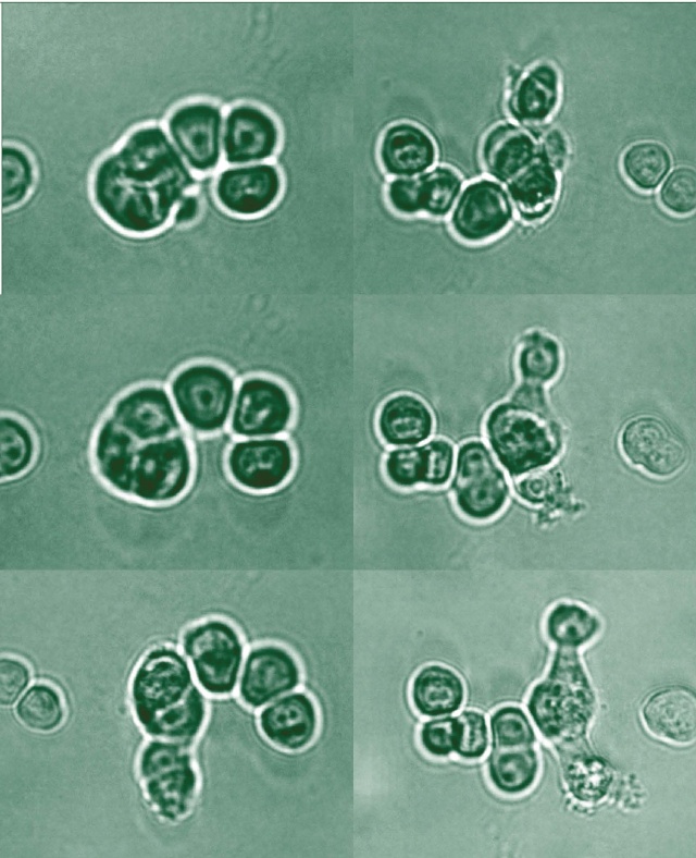 Prostate cancer cells. (FROM THE LABORATORY OF LESZEK KOTULA, MD, PhD)