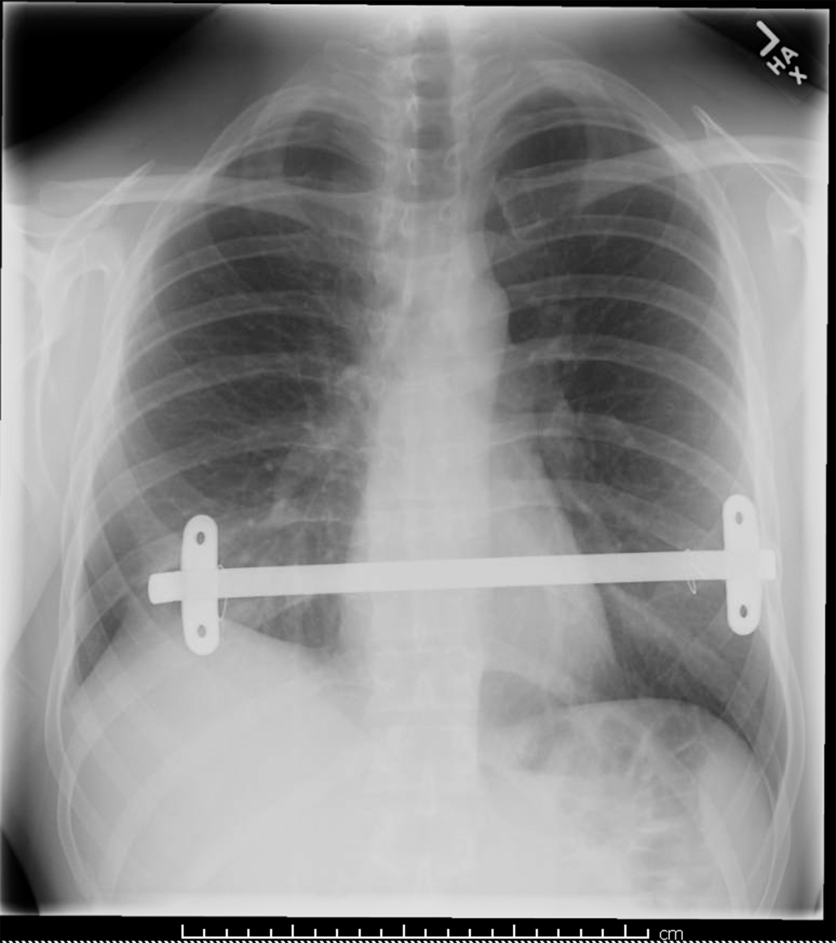 This X-ray shows a surgically inserted metal bar that will help to correct a sunken chest, a somewhat rare condition.