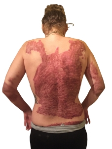 Bridge shows her skin grafts prior to laser treatments. (PHOTO BY SUSAN KAHN)