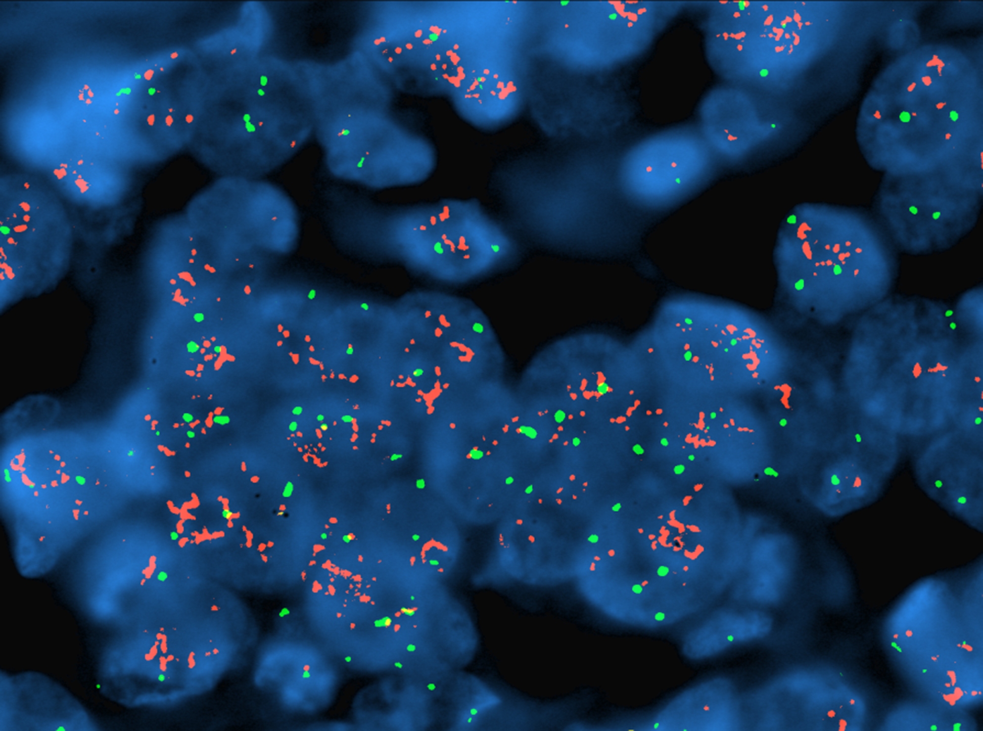 This image, made with fluorescent probes, shows amplification of HER2, a gene that can play a role in breast cancer. (from the lab of Steven Sperber, PhD)