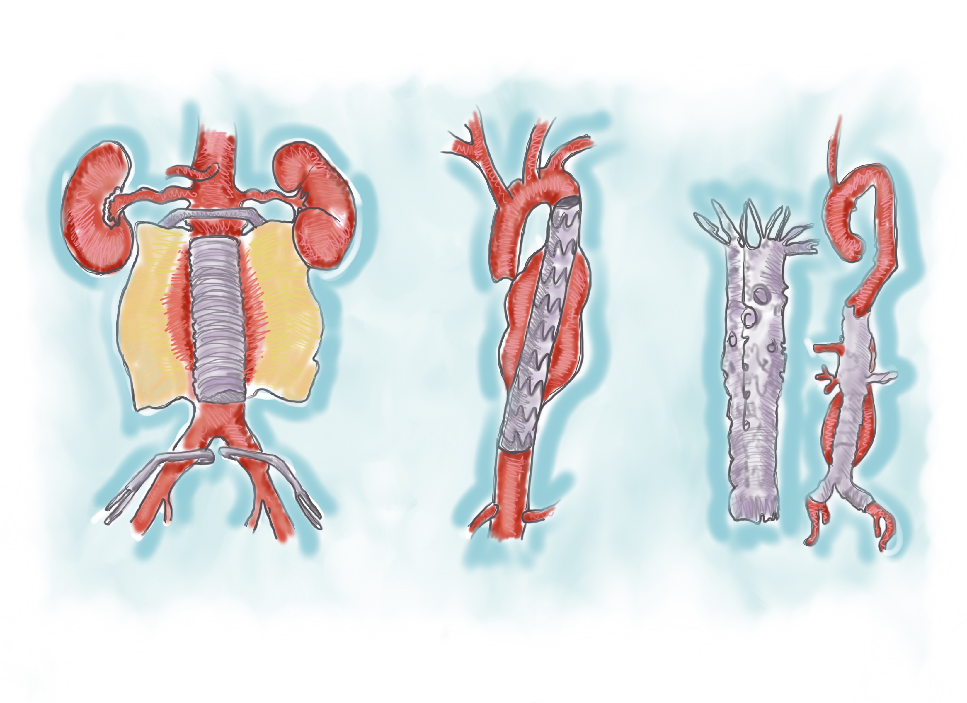 Three ways of repairing abdominal aortic aneurysms: (from left) traditional open surgical repair, endograft for AAA repair, fenestrated endograft.