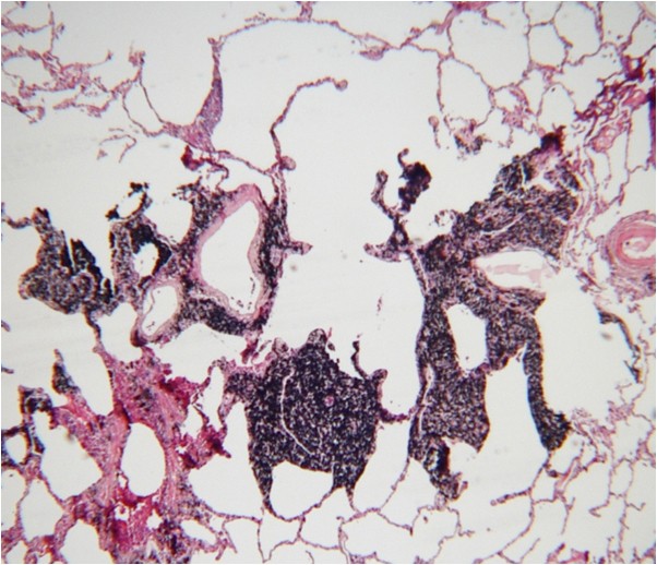 Microscopic views of a coal miner‘s lung. Dark coal macules (collections of coal dust in the lung cells)