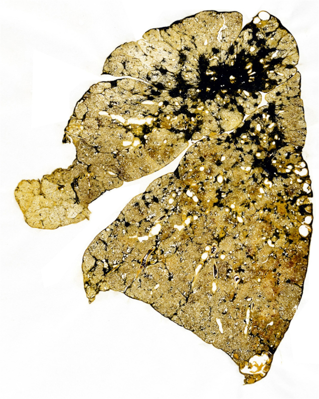 Slice of a coal miner‘s lung. Black area shows progressive massive fibrosis.