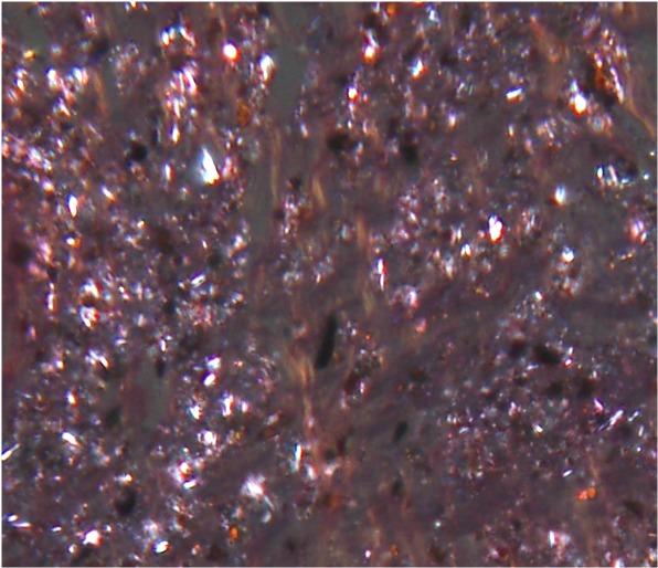 dust in the lungs comprised of coal (black) and silicate (bright) particles.