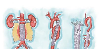 Different types of aneurysms call for different types of repairs