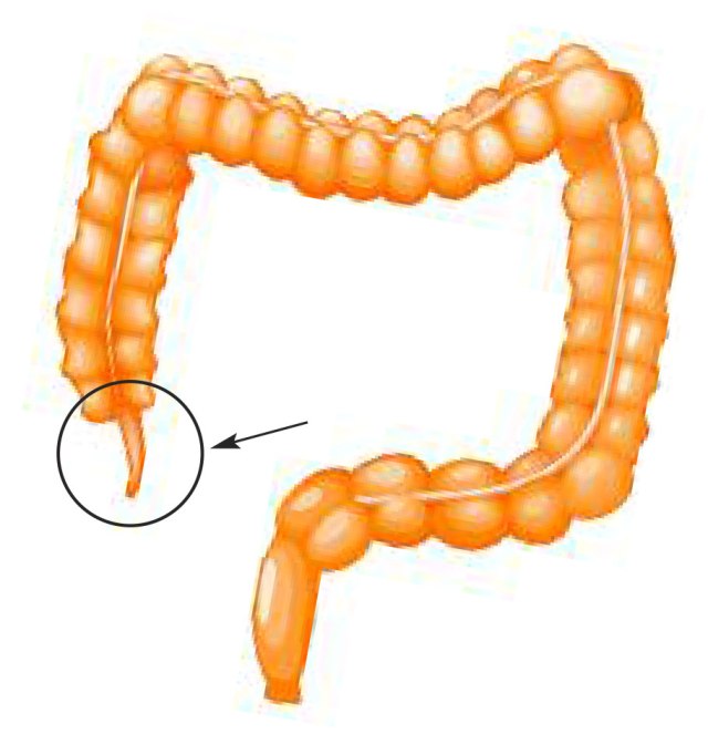 The appendix, shown in the circled area, is a pouch near where the large and small intestines meet. It varies in size from person to person but may range from less than an inch to 6 inches in length.