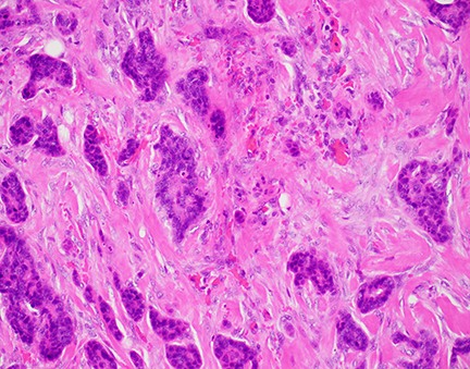 Pathologists view cancer cells at the microscopic level, above, run tests and issue reports with a patient's test results but do not often interact directly with patients. An Upstate pathologist is taking a different approach and is happy to meet with patients to help explain what their pathology results mean.