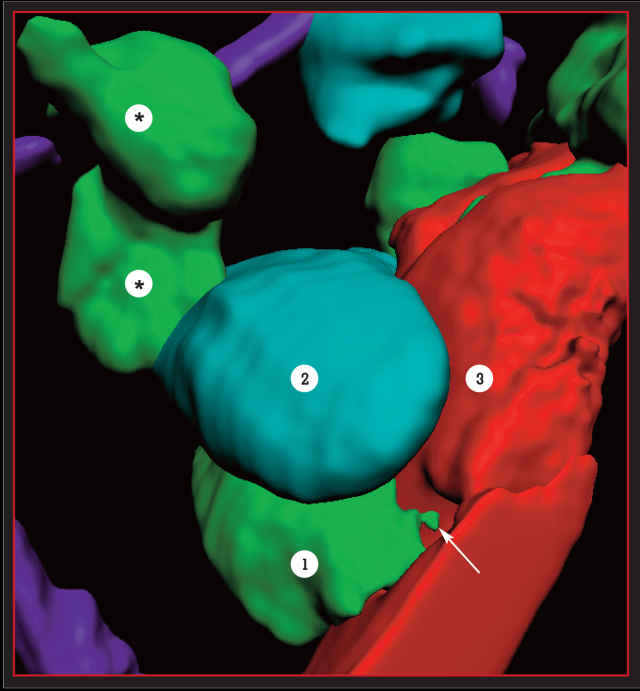 Here’s how breast cancer can spread: A tumor cell (green, No. 1), is in direct contact with a macrophage (blue, No. 2) and an endothelial cell (red, No. 3). The macrophage is a part of the immune system, and the endothelial cell is part of a blood vessel wall. The tumor cell makes an invasive protrusion called an invadopodium (white arrow) that cuts a doorway into the blood vessel. Other tumor cells (green, marked with *) then leave the tumor, pass through that opening into the bloodstream and travel to new parts of the body, where they can start new tumors. Collagen fibers are shown in purple. This illustration is based on live microscopic imaging of a mouse with a mammary tumor (image courtesy of Peng Guo)