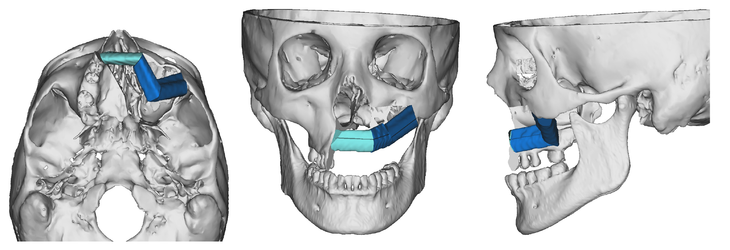 Computer model of Michele Giblin's reconstructive surgery. The areas in shades of blue show what was rebuilt. (courtesy of Jesse Ryan, MD)
