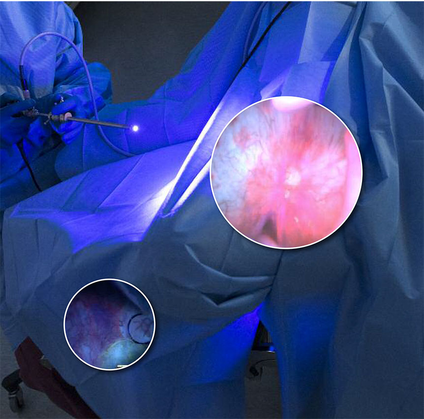 The background photo shows Joseph Jacob, MD, demonstrating Blue Light Cystoscopy. The insets show cancer cells. (Background photo by Susan Kahn. Inset photos courtesy of Joseph Jacob, MD)Jacob, MD.)