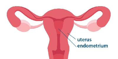 3 facts about endometrial cancer