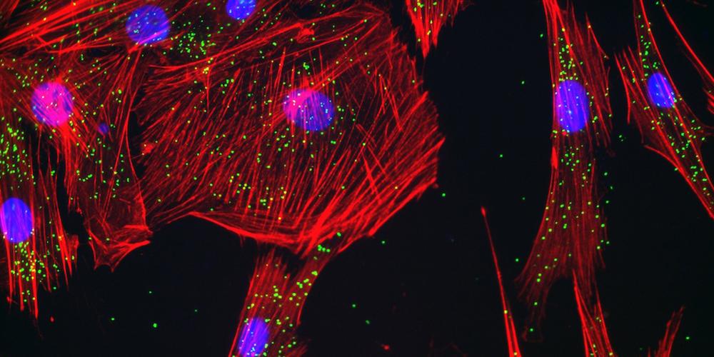 A myofibroblast in culture; the actin is shown in red, the proteins as green dots and the nucleus in blue. (image by Edward Boumil, PhD, in the Bernstein lab at Upstate)