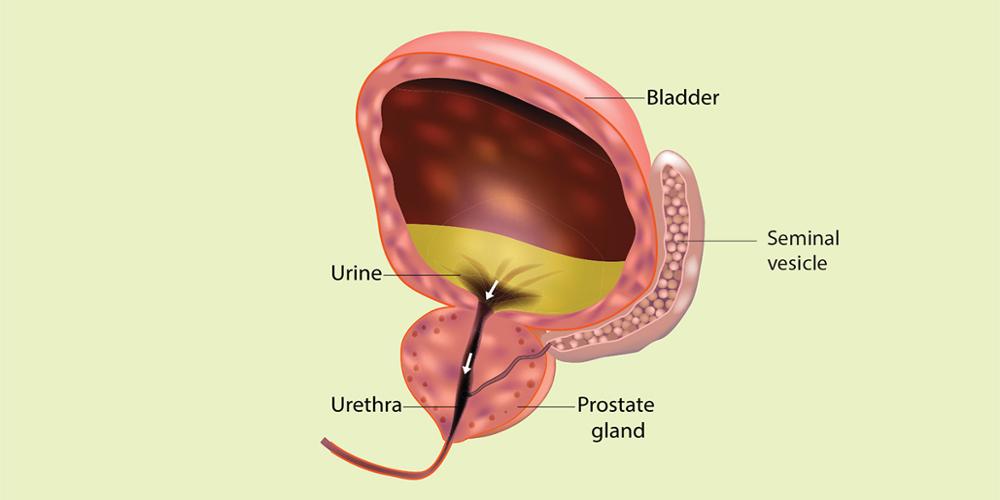 The prostate gland, shown in this cutaway view, can develop cancer later in a man’s life, typically in his 60s or 70s.