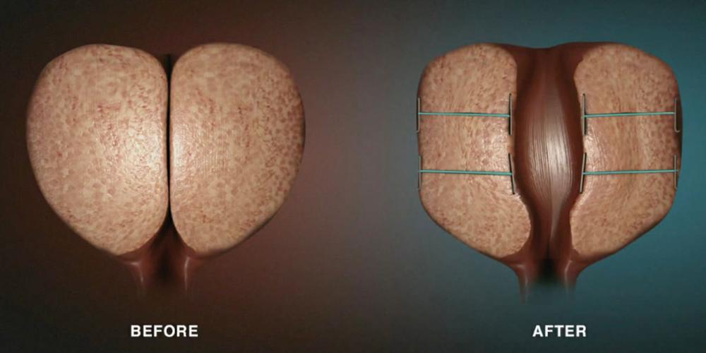 Before and after images of how UroLift widens the urethra for improved urine flow in cases of an enlarged prostate.