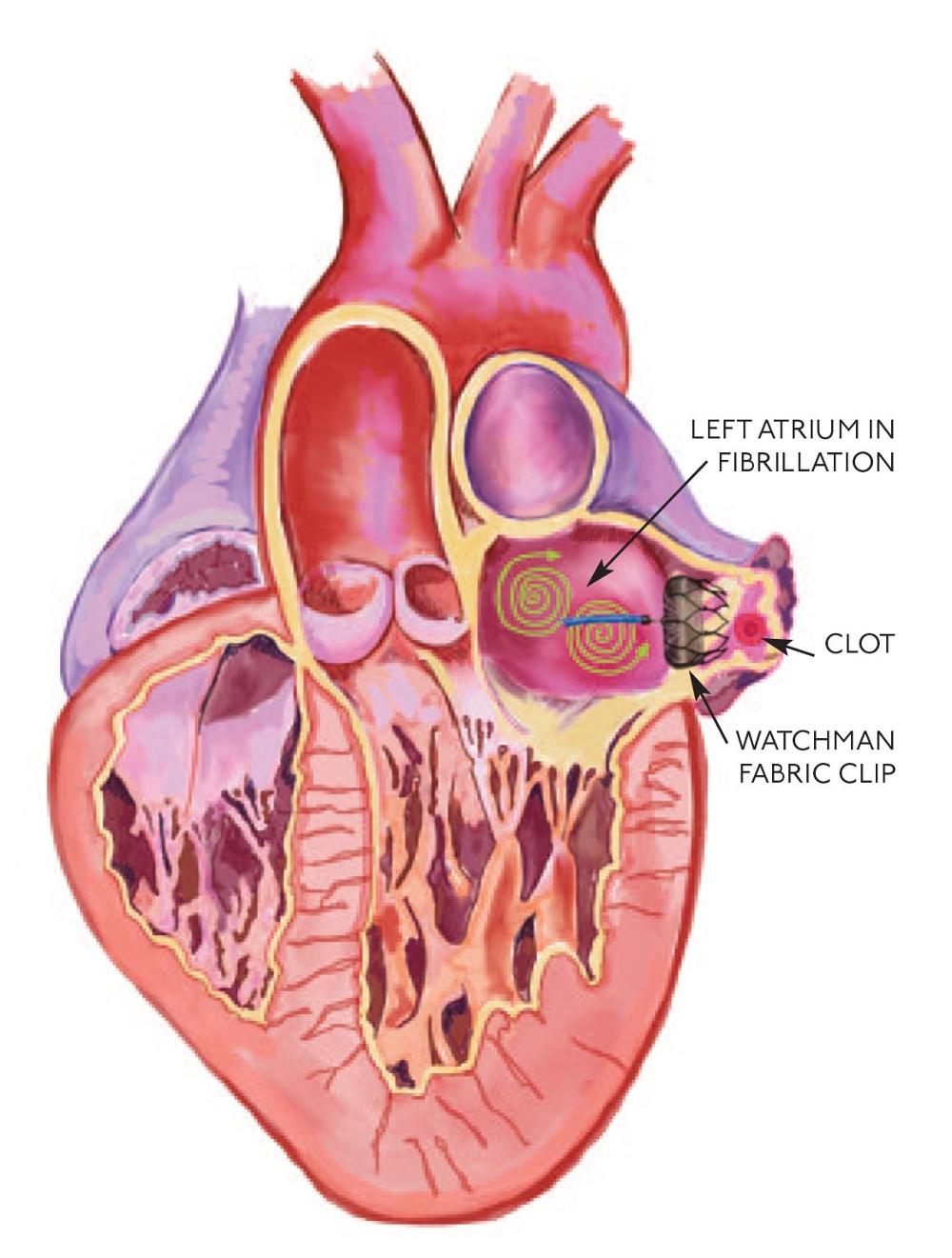 Atrial fibrillation can be treated by a procedure called TT Maze to help reduce the risk of stroke. The Watchman procedure also reduces stroke risk.
