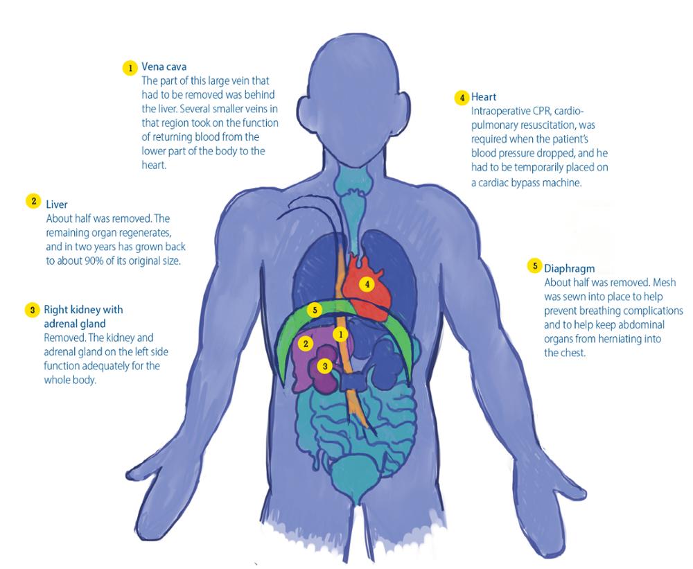 Upstate surgeons removed a 16-pound tumor, along with adjacent organs and vessels, from Pass’ abdomen. Pathologists found no cancer cells along the edges of the tissue, a desired outcome.