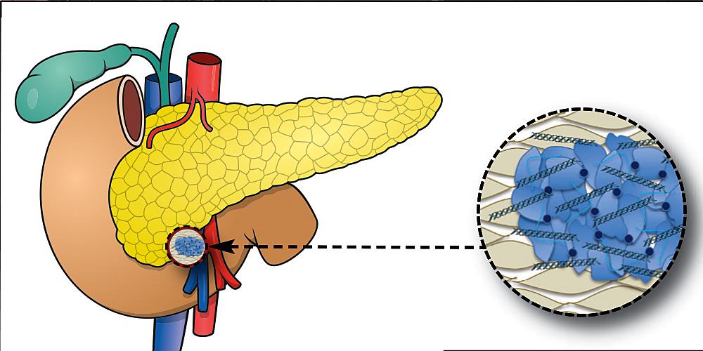 The stroma (shown in blue in the inset circle) is a framework of connective tissue supporting and anchoring the pancreas (shown in yellow) or any internal organ.