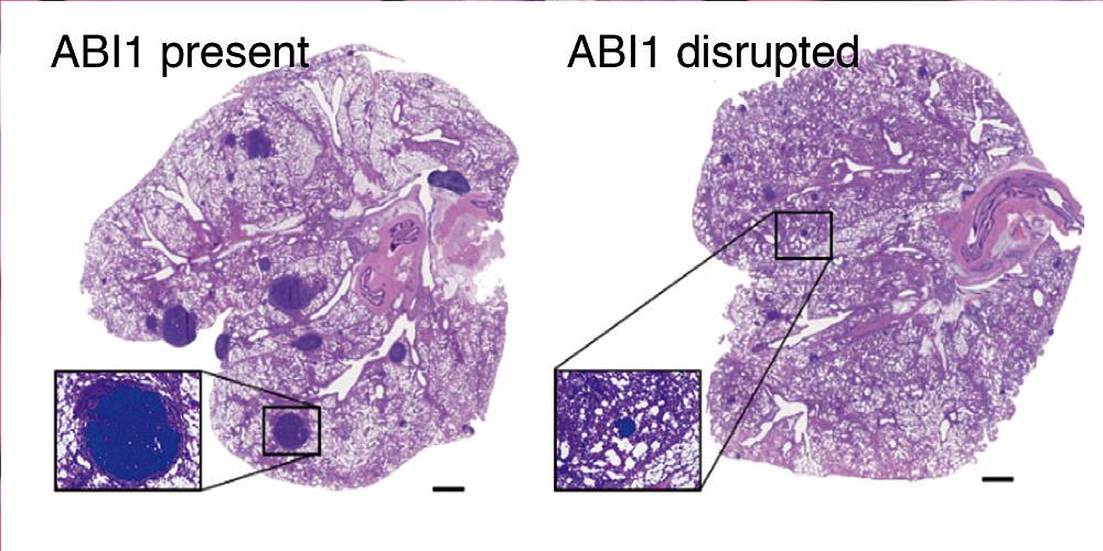 Breast cancer that has spread to the lungs of lab mice with the ABI1 gene (left) and without it (right). The sample with the gene has more and larger metastatic foci; disruption of the gene decreases those foci.