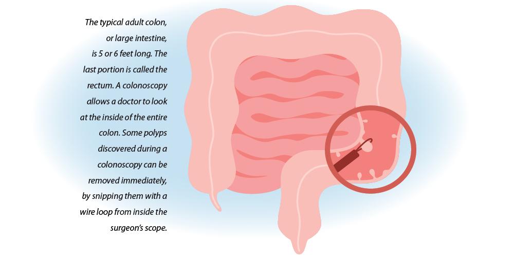 Diagram of an adult colon, or large intestine, and how a surgeon can snip off some polyps with the scope used for a colonoscopy.