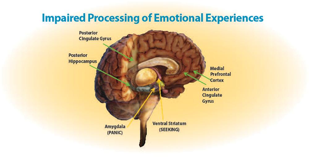 Higher-level regions of the brain (green arrows) either atrophy or underreact to emotional situations; lower regions (yellow arrows) become hyperreactive -- leading to a high arousal and impulsive pleasure-seeking.